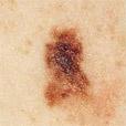Kaj bi vsakdo moral vedeti o malignem melanomu?
