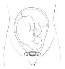 Urinska inkontinenca pri ženskah