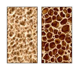 Za osteoporozo je značilna nižja gostota kosti (slika desno)