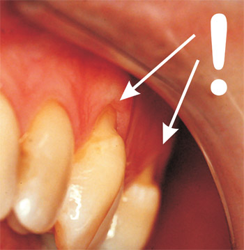 parodontalna bolezen